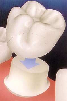 Image of crowns on teeth