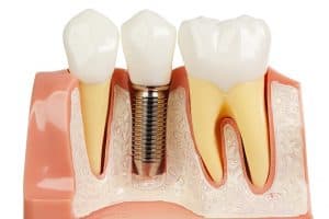 tooth-pin-retention